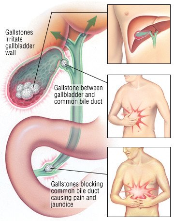 Gallstones