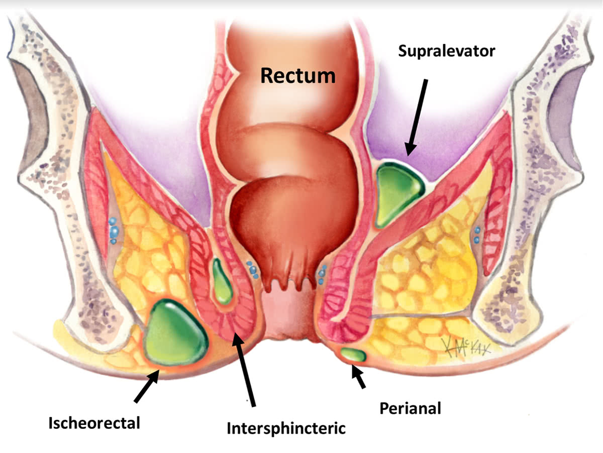 Perianal abscess