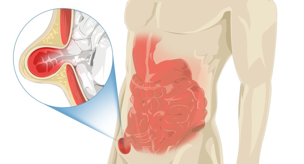 Femoral hernia repair