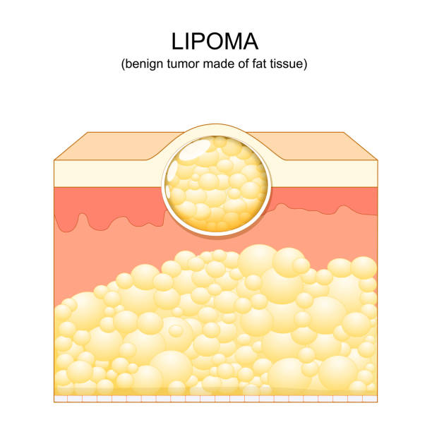 Lipoma