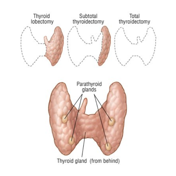 Thyroidectomy