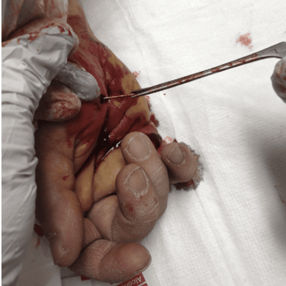 Removal Of Foreign Bodies From Soft Tissue ​
